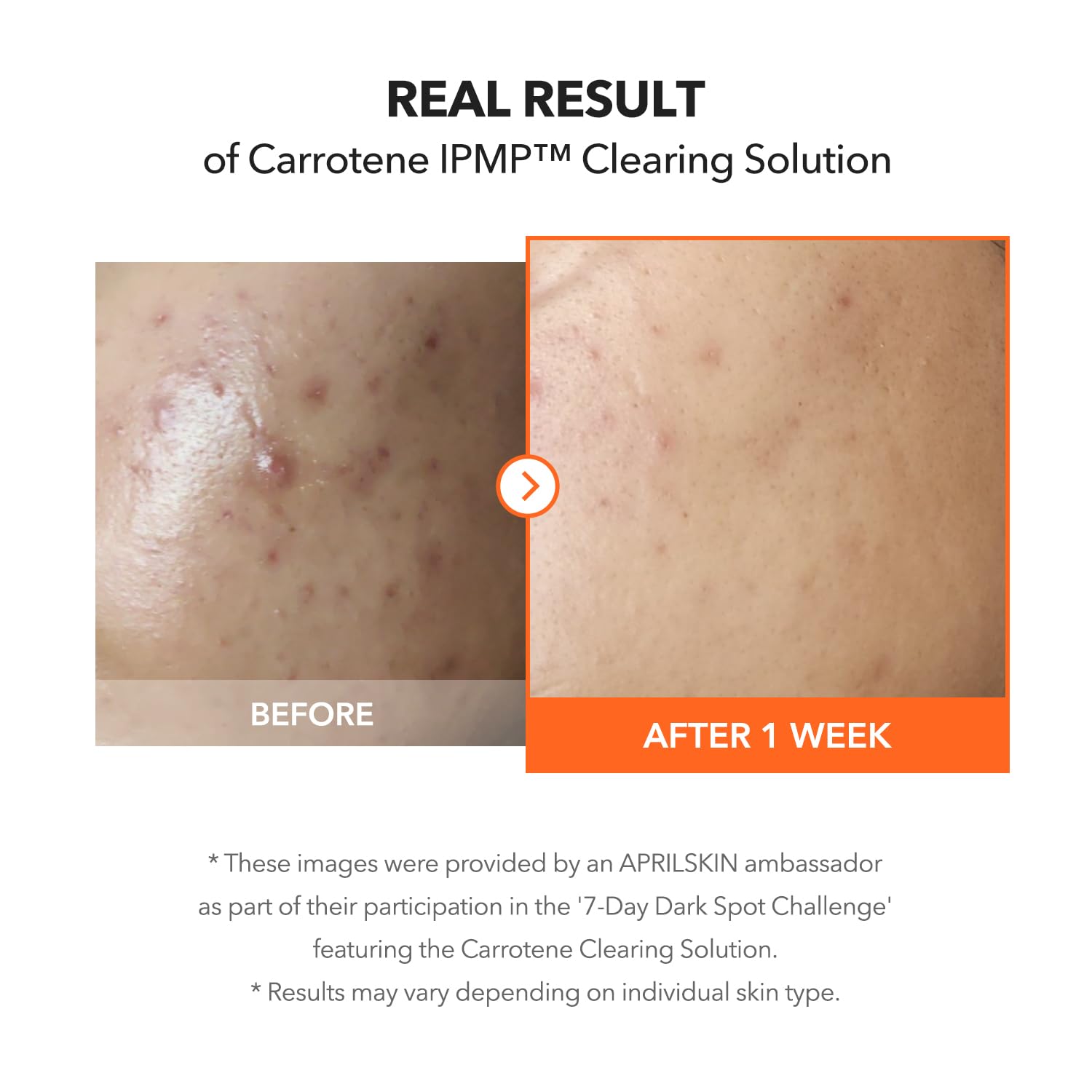 Soothe & Clear Acne with APRILSKIN Carrotene IPMP Solution - BHA/AHA/Niacinamide, 0.67 fl oz