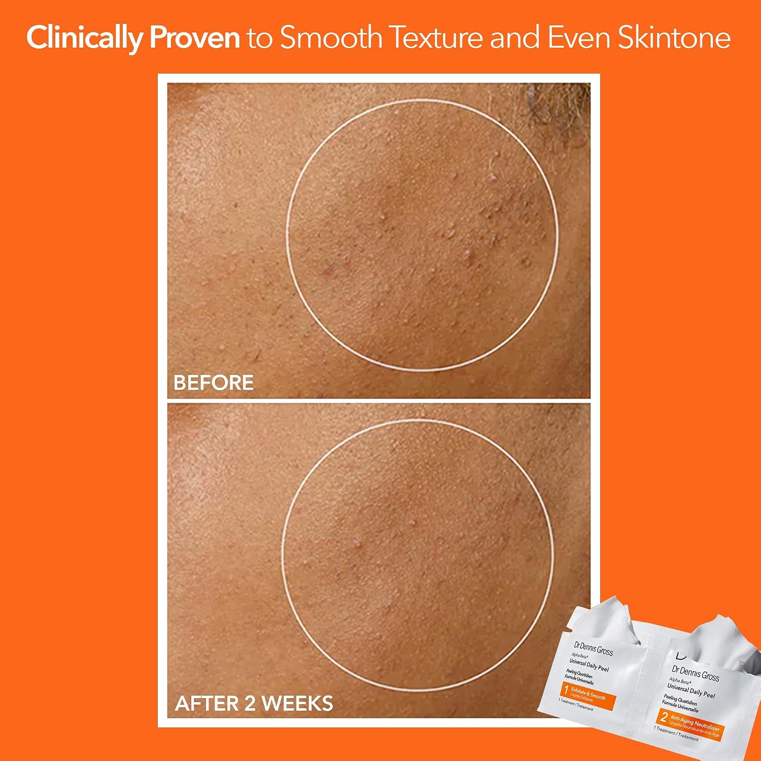 Dr Dennis Gross Alpha Beta Universal Daily Peel: For Uneven Tone & Fine Lines, 5 Treatments