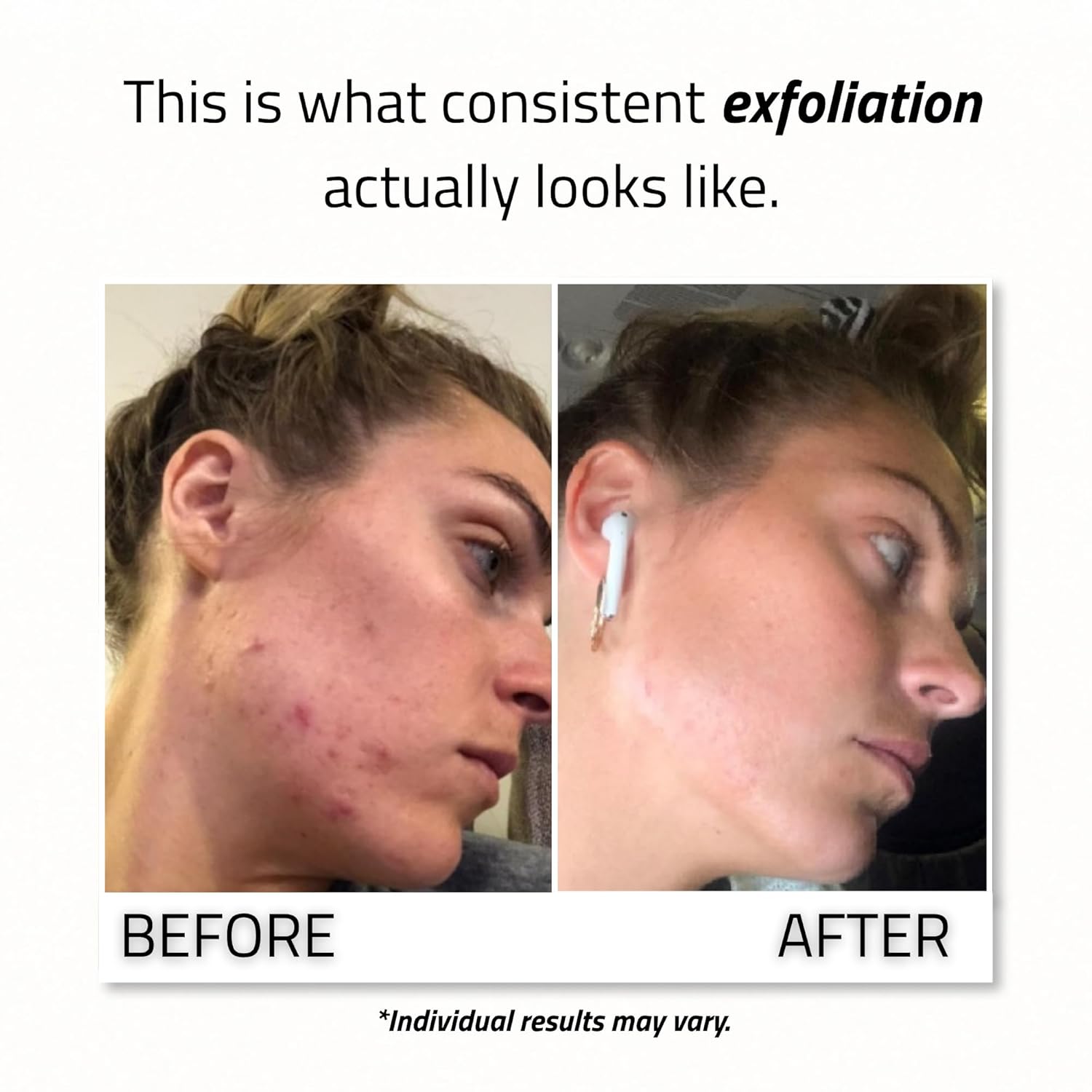 YEOUTH 30% Glycolic Acid Face Peel with Retinol & Green Tea - Exfoliate Uneven Skin Texture, Dullness & Fine Lines