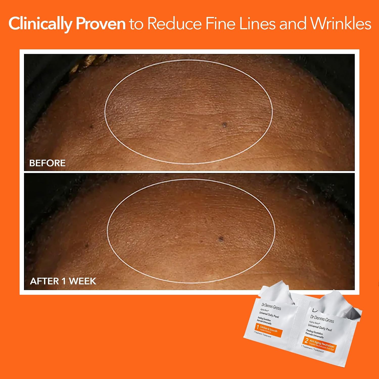 Dr Dennis Gross Alpha Beta Universal Daily Peel: For Uneven Tone & Fine Lines, 5 Treatments
