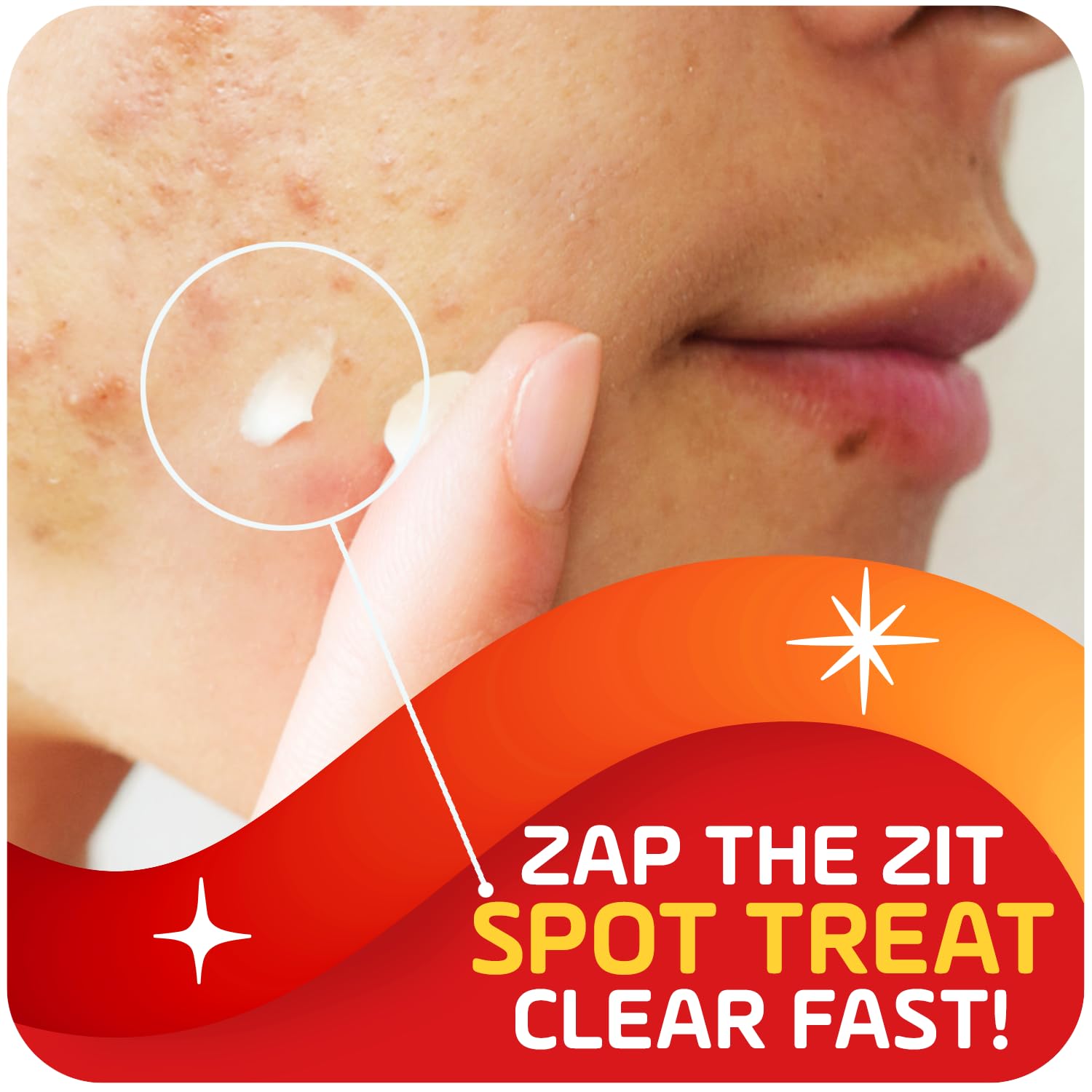Asepxia 2% Salicylic Acid Acne Spot Treatment Cream for Rapid Breakout Control