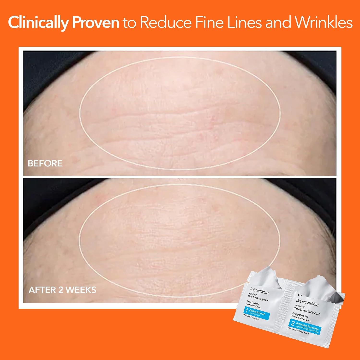 Dr. Dennis Gross Alpha Beta Ultra Gentle Daily Peel Pads for Dehydrated/Sensitive Skin (5 Treatments)