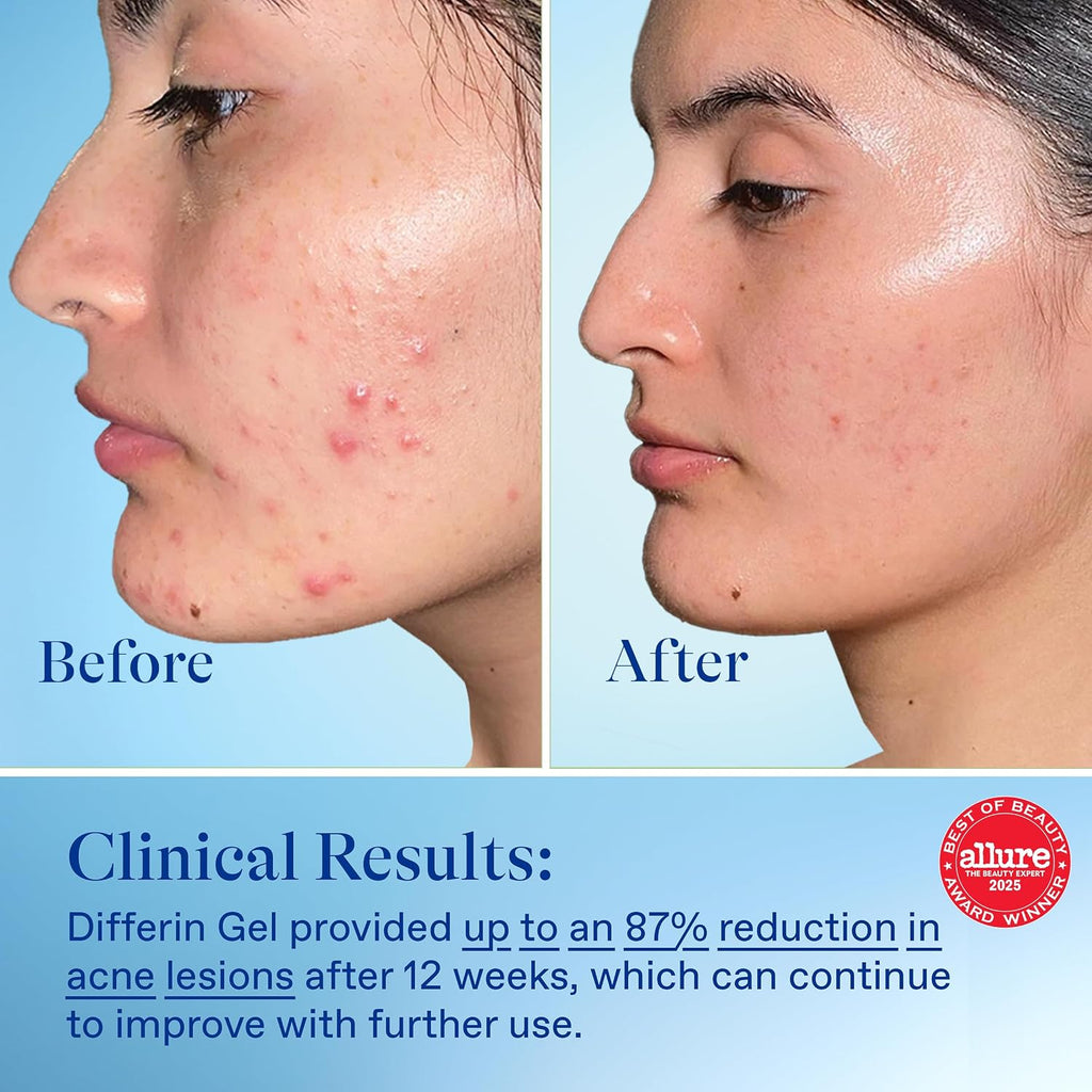 Differin Acne Treatment Gel - 0.1% Retinoid for Clear Skin, 45g Pump