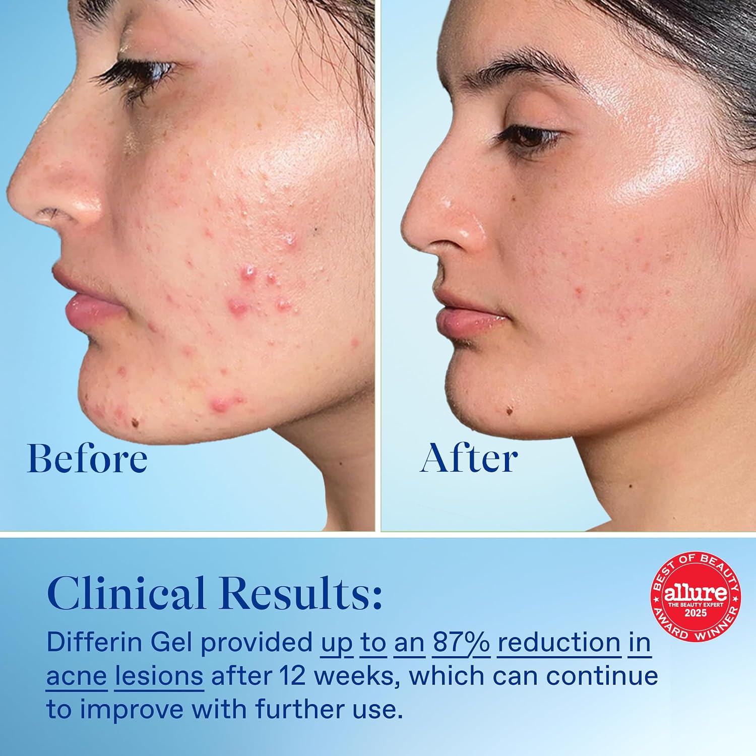 Differin Acne Treatment Gel - 0.1% Retinoid for Clear Skin, 45g Pump