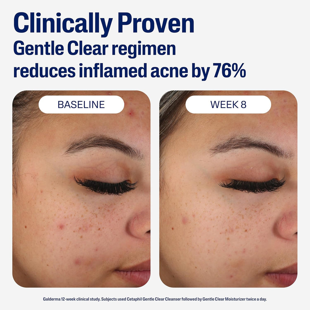 Cetaphil Gentle Acne Moisturizer with 0.5% Salicylic Acid for Sensitive Skin, 3oz