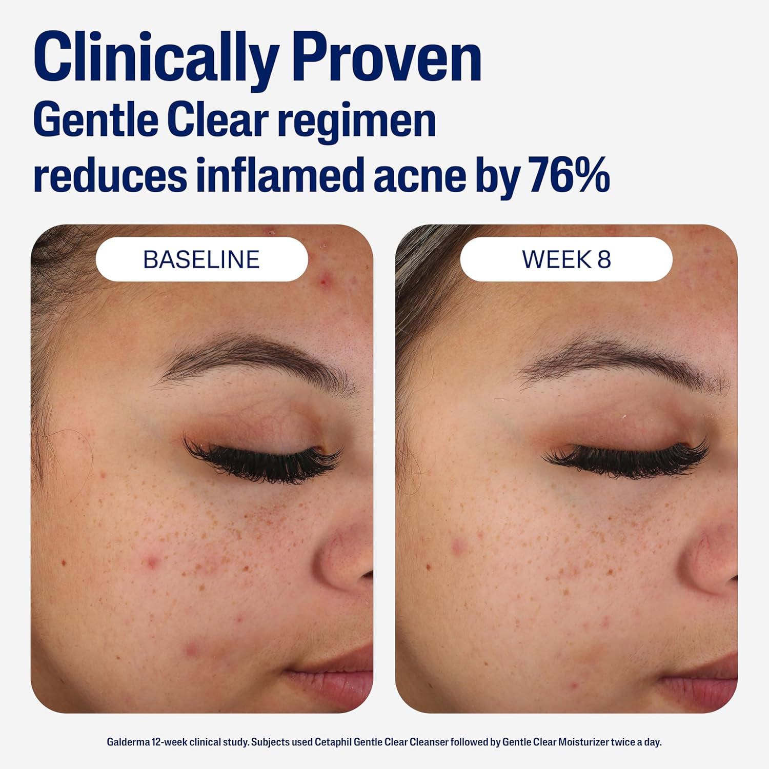 Cetaphil Gentle Acne Moisturizer with 0.5% Salicylic Acid for Sensitive Skin, 3oz