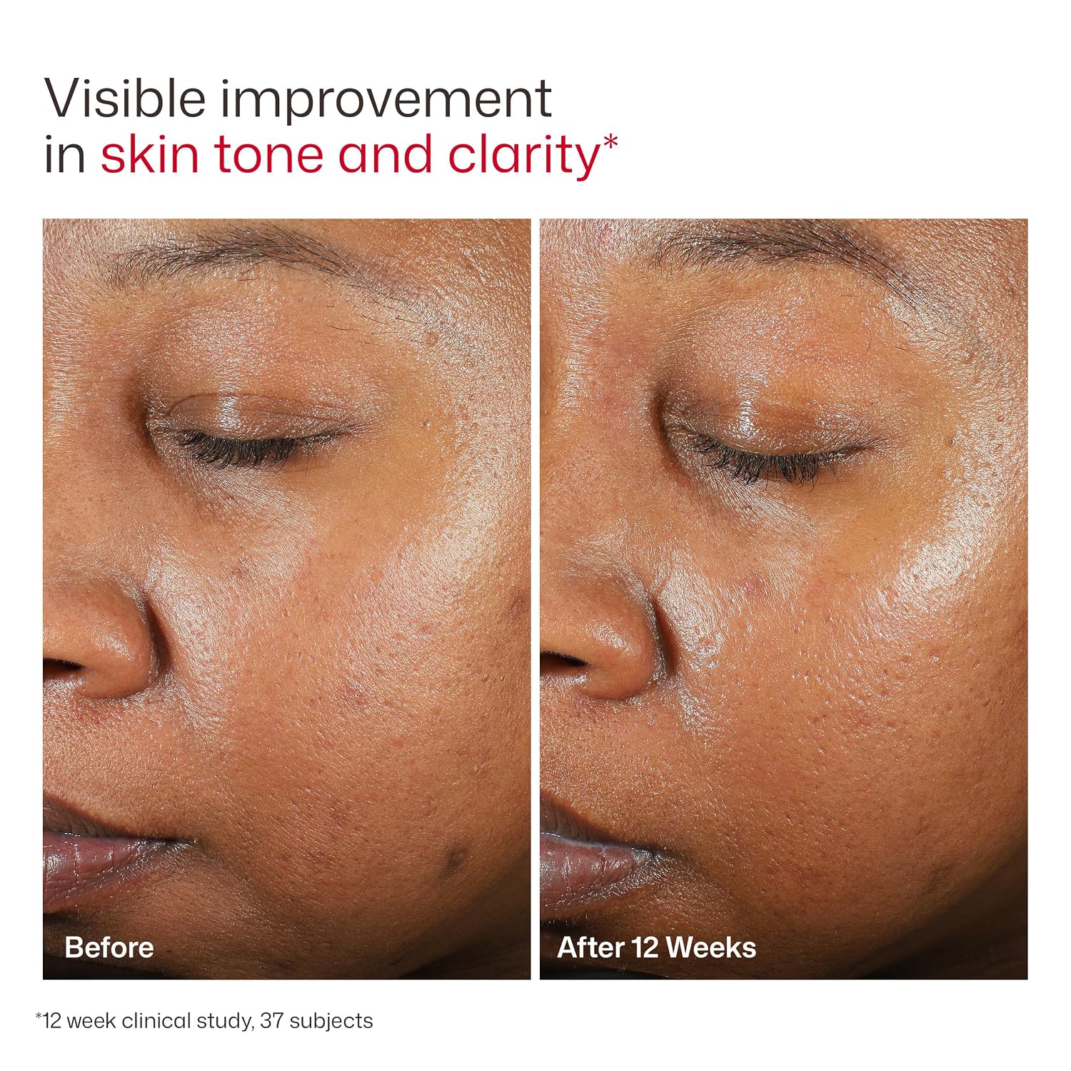 EltaMD UV Clear Face Sunscreen SPF 46 - Oil-Free Zinc Oxide Sunscreen for Sensitive Skin